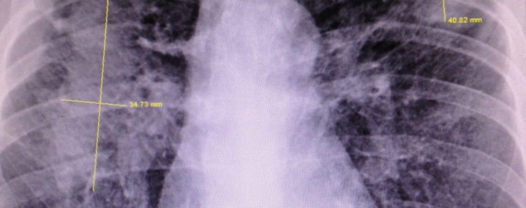 an x-ray of lungs showing scarring